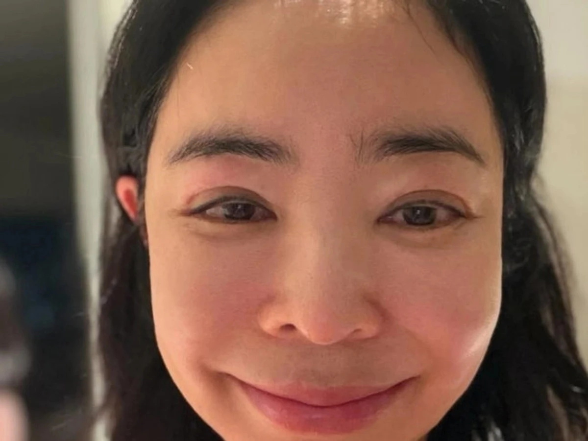 “脸肿得厉害”……‘肺癌手术’李惠英，淋巴水肿后遗症坦白