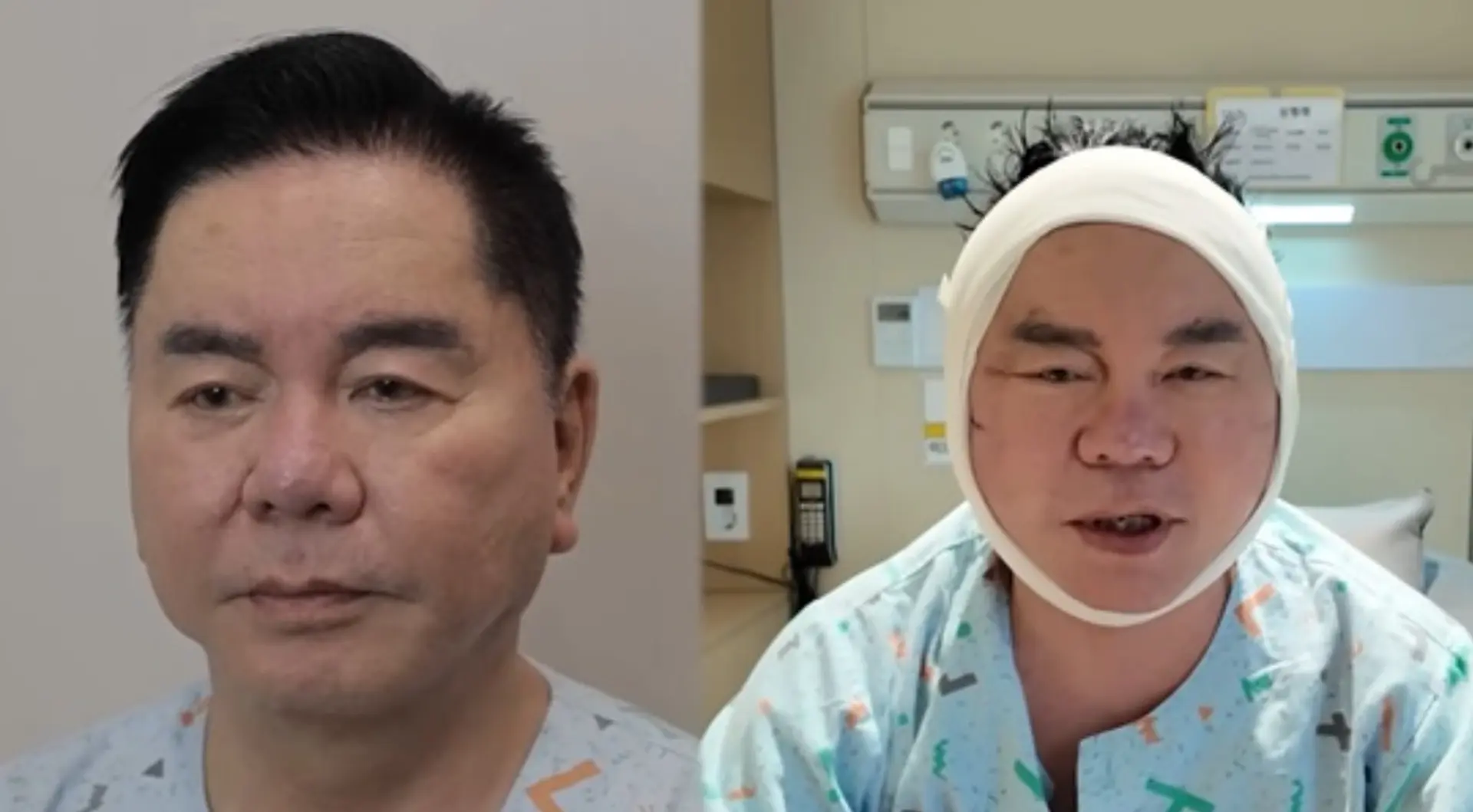 '영구' 심형래, 안면거상 재수술 후 모습 공개...팬들 위해 얼굴 리모델링 결단