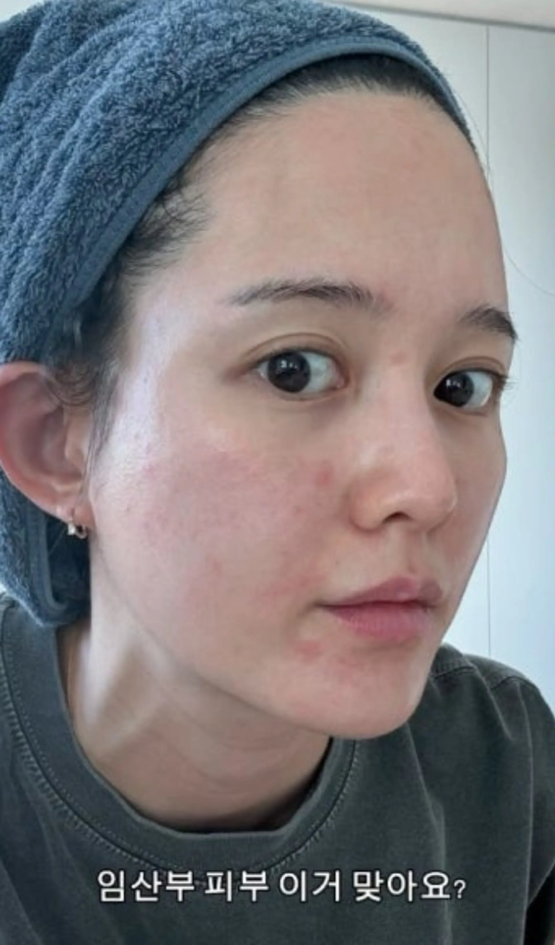 "호르몬의 노예" 남보라, 임신 후 뒤집어진 피부… 고충 토로