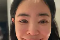 “脸肿得厉害”……‘肺癌手术’李惠英，淋巴水肿后遗症坦白