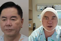 '영구' 심형래, 안면거상 재수술 후 모습 공개...팬들 위해 얼굴 리모델링 결단
