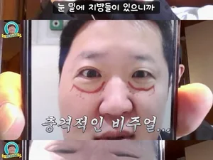Jung Hyung-don Reveals His Appearance Right After 'Under-Eye Fat Relocation' Surgery, Says 