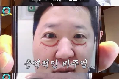 정형돈, '눈밑지방재배치' 수술 직후 모습 공개하며 