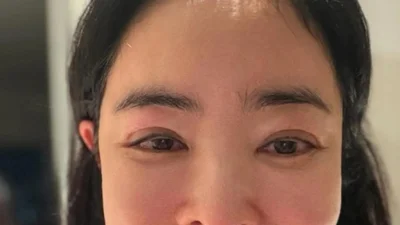 “脸肿得厉害”……‘肺癌手术’李惠英，淋巴水肿后遗症坦白