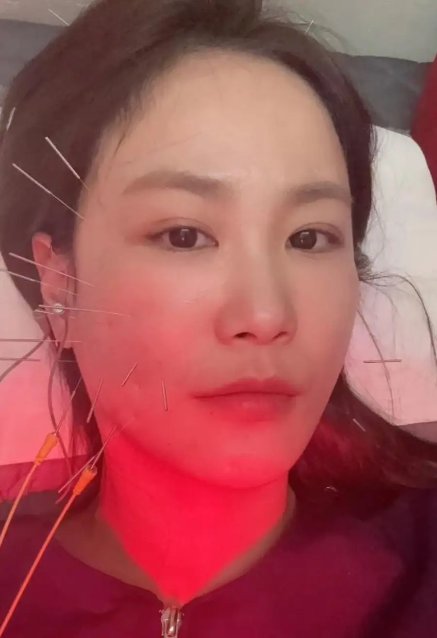 Kim Ji-min aksidente sa pagbagsak at pinsala sa mukha